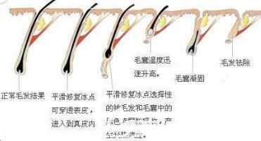 冰點(diǎn)脫毛術(shù)后注意事項(xiàng)