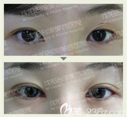 沈陽名流整形雙眼皮真人前后對比照片