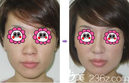 沈陽名流鼻整形真人前后對比照