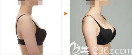 沈陽名流胸部整形真人前后對比照