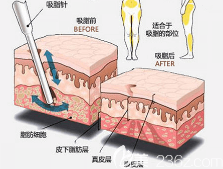 北京藝美吸脂前后效果示意圖