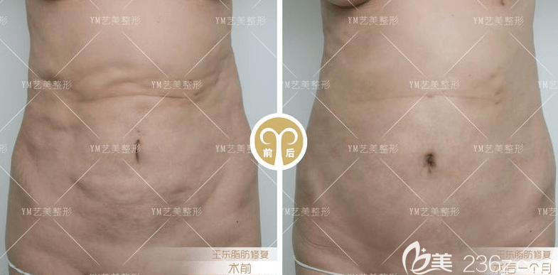 北京藝美王東醫(yī)生腰腹部吸脂案例