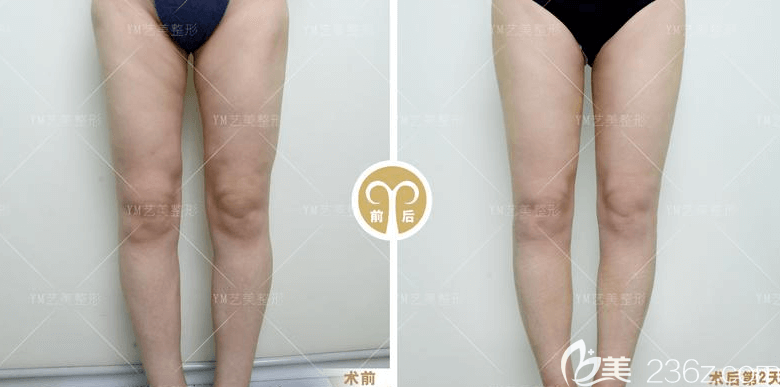 北京藝美王東醫(yī)生腿部吸脂失敗修復(fù)案例