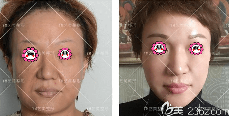北京藝美王東醫(yī)生面部吸脂失敗修復(fù)案例