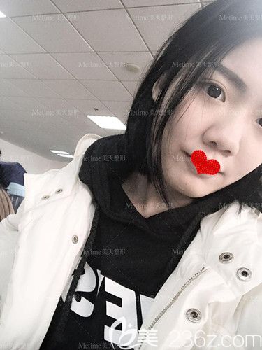 在承德美天做隆鼻前是塌平鼻 在承德美天做隆鼻前是塌平鼻