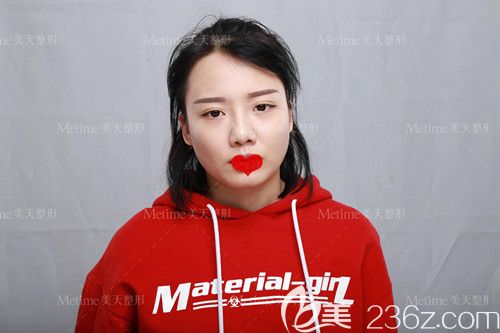 不在承德美天做一次自體軟骨隆鼻術(shù) 真不知道我的塌平鼻竟也能變成親媽款高挺鼻