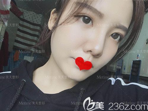 郭東超為我做鼻綜合術(shù)后10天鼻子消腫 郭東超為我做鼻綜合術(shù)后10天鼻子消腫