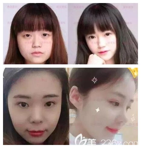 長沙雅美眼鼻整形真人前后效果對比圖