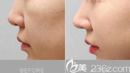 長沙亞韓鼻整形真人前后對比圖