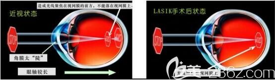 醫(yī)院整形美容科張彩云激光矯正近視 醫(yī)院整形美容科張彩云激光矯正近視