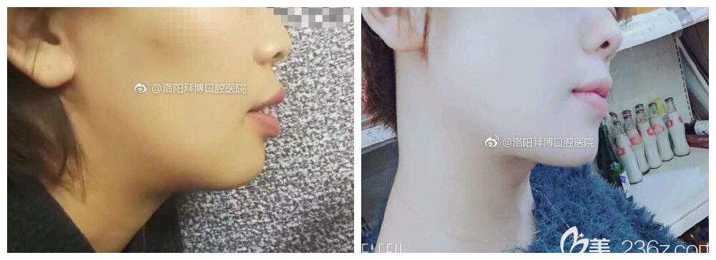洛陽拜博口腔的真人矯正案例