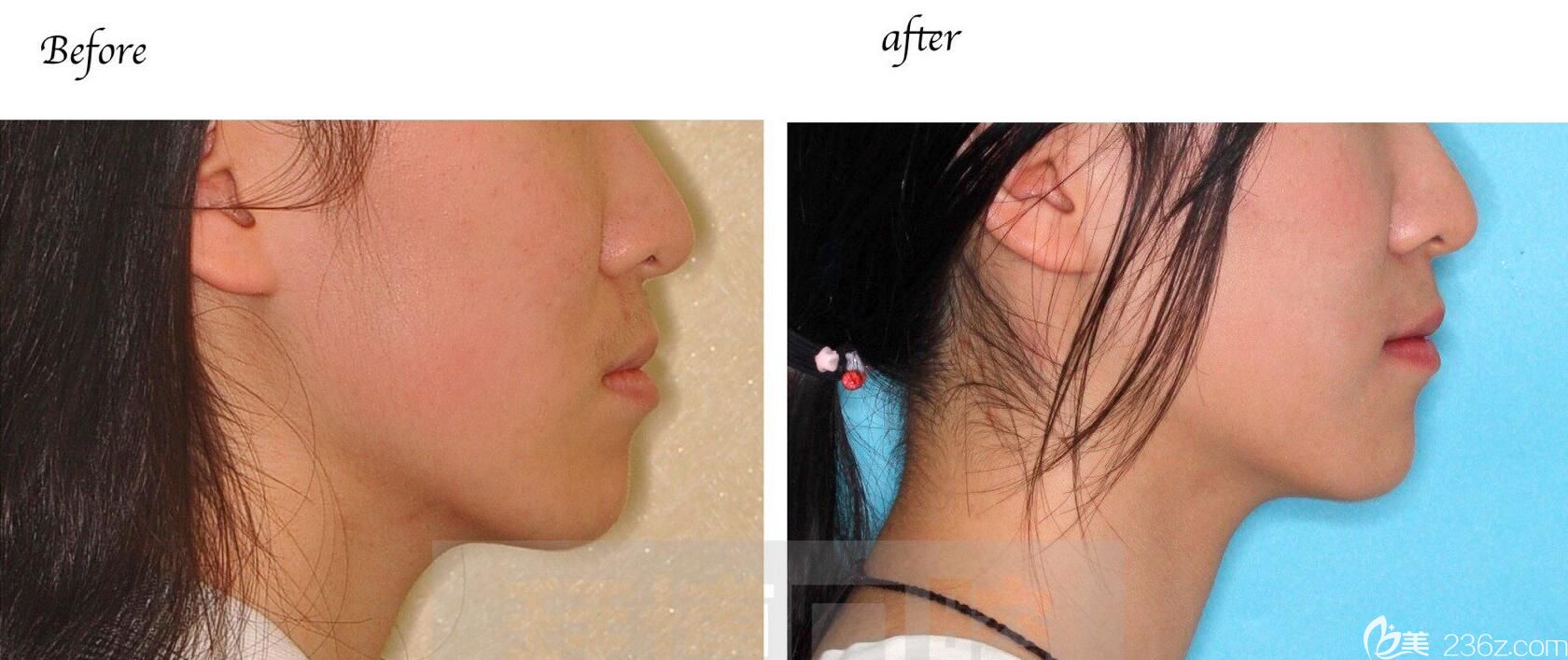 洛陽拜博口腔又一個牙套美女畢業(yè)啦