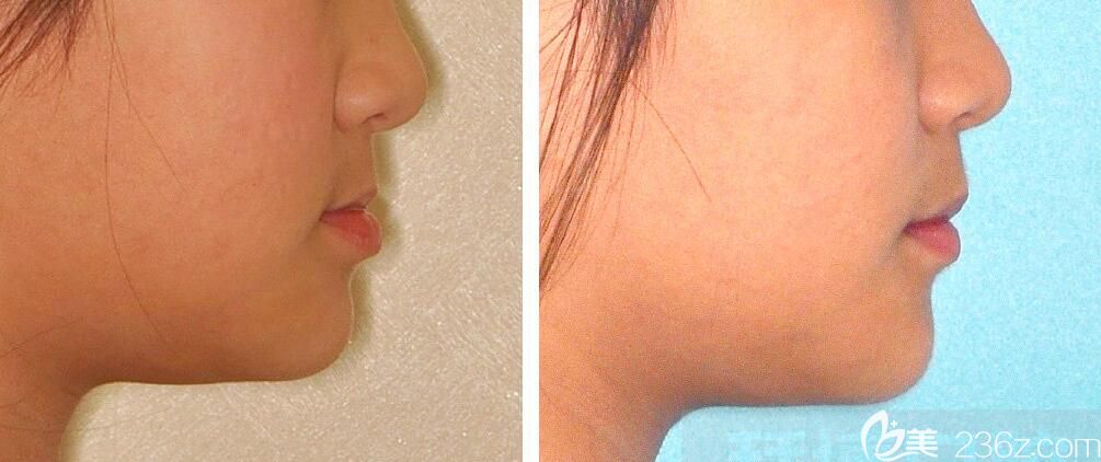 10歲小女生地包天矯正后變開朗自信