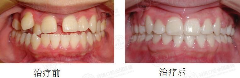 拜博口腔小妹妹牙齒擁擠不齊，雙頜前突矯正案例前后對比