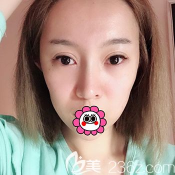 自體脂肪填充全臉前 自體脂肪填充全臉前