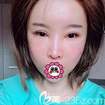 自體脂肪填充面部第6天 自體脂肪填充面部第6天