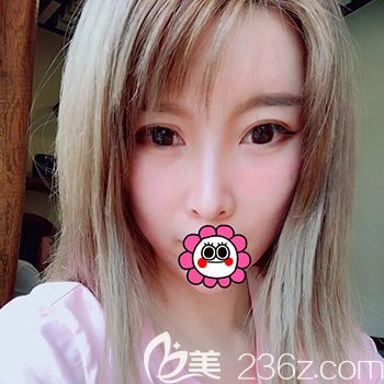 哈爾濱臻美自體脂肪填充臉部一個(gè)月 哈爾濱臻美自體脂肪填充臉部一個(gè)月