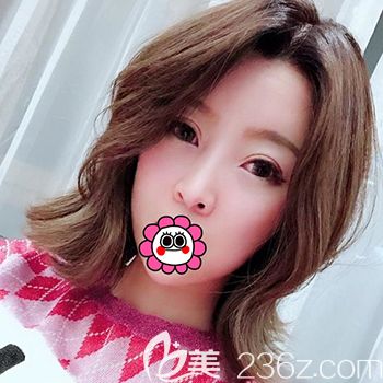 以前一直注射玻尿酸，這次到哈爾濱臻美找院長用自體脂肪+PRP填充全臉看效果怎么樣