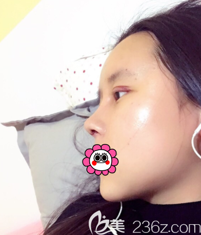 鞏敏醫(yī)生給我做眼綜合和鼻綜合第3天樣子