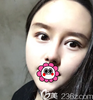 在北京藝美做眼綜合和鼻綜合第38天效果