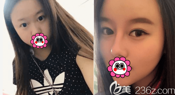 北京藝美鞏敏醫(yī)生眼綜合和鼻綜合案例