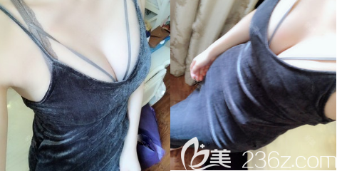 <i data-id='886cabca-d73c-4ec2-aad1-c9bb00ca5f38' style='display:none;'></i>蒲小兵自體脂肪豐胸一年效果 <i data-id='886cabca-d73c-4ec2-aad1-c9bb00ca5f38' style='display:none;'></i>蒲小兵自體脂肪豐胸一年效果