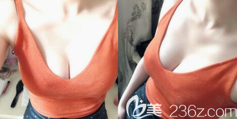自體脂肪豐胸術(shù)后3個(gè)月效果圖 自體脂肪豐胸術(shù)后3個(gè)月效果圖