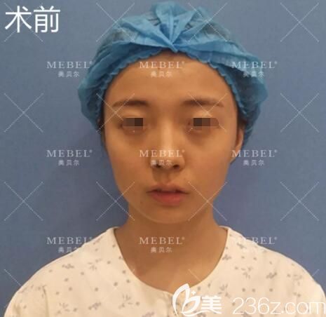 面診揚(yáng)州美貝爾術(shù)前鼻子塌陷 面診揚(yáng)州美貝爾術(shù)前鼻子塌陷