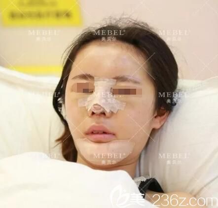 剛做完硅膠體墊鼻梁+肋軟骨塑鼻頭+下巴整形術(shù)后即刻效果 剛做完硅膠體墊鼻梁+肋軟骨塑鼻頭+下巴整形術(shù)后即刻效果