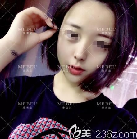 張成春醫(yī)生分享做硅膠體墊鼻梁+肋軟骨塑鼻頭+下巴整形術(shù)后半月效果 張成春醫(yī)生分享做硅膠體墊鼻梁+肋軟骨塑鼻頭+下巴整形術(shù)后半月效果