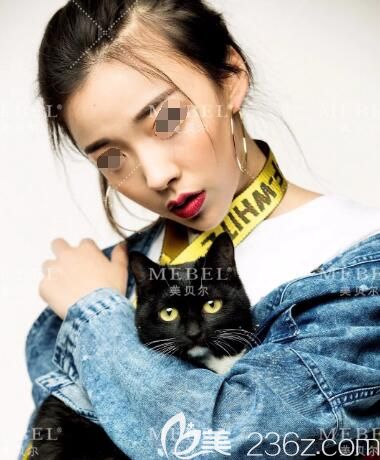 不甘心做路人面診揚(yáng)州美貝爾張成春醫(yī)生做了硅膠體墊鼻梁+肋軟骨塑鼻頭+下巴整形 不到8000元的術(shù)后效果真的值了