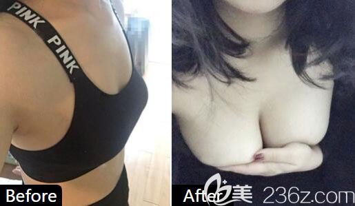 韓國魔笛motiva假體隆胸案例效果對比圖