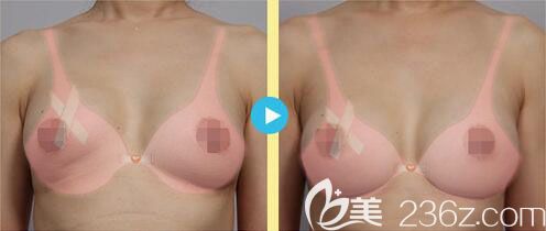 韓國麥恩假體隆胸失敗修復(fù)真人案例