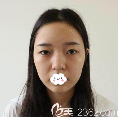 眼鼻整形手術(shù)前照片 眼鼻整形手術(shù)前照片