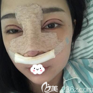 鐘正強做眼睛鼻子術(shù)后即刻照 鐘正強做眼睛鼻子術(shù)后即刻照