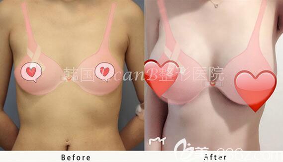 韓國ucanb隆胸怎么樣？金駿昊院長貝拉假體隆胸案例