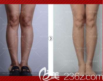 北京藝美王東醫(yī)生O型腿矯正案例 北京藝美王東醫(yī)生O型腿矯正案例