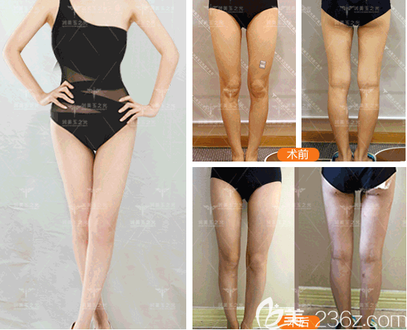 北京潤美玉之光王明利醫(yī)生O型腿矯正案例 北京潤美玉之光王明利醫(yī)生O型腿矯正案例