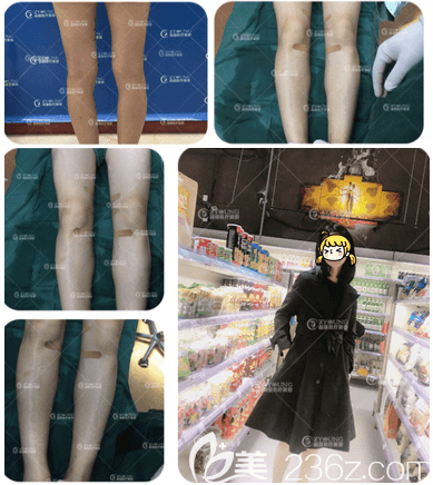 北京卓顏蕊麗趙禹翔OX型腿矯正案例 北京卓顏蕊麗趙禹翔OX型腿矯正案例