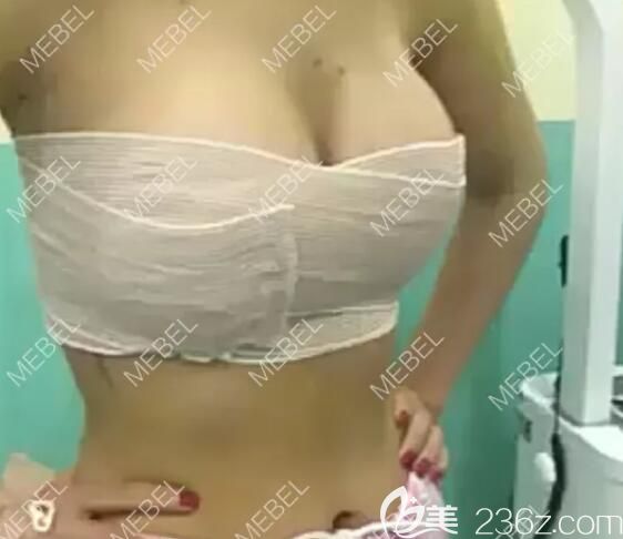 剛做完自體脂肪填充胸部術(shù)后即刻效果 剛做完自體脂肪填充胸部術(shù)后即刻效果