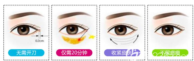 不開刀祛眼袋手術(shù)示意圖