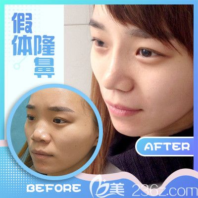 梅州曙光整形醫(yī)院隆鼻手術(shù)案例 梅州曙光整形醫(yī)院隆鼻手術(shù)案例