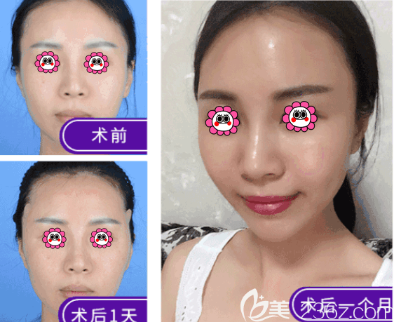 北京藝美王東醫(yī)生太陽穴生長因子取出修復(fù)案例