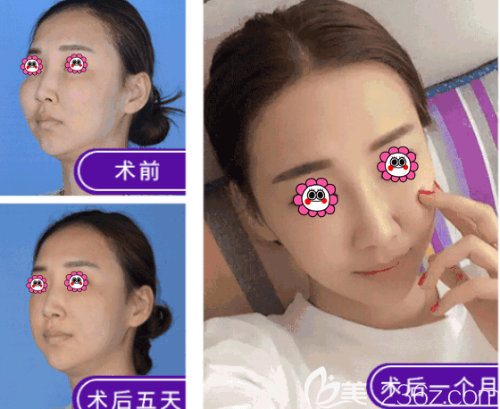 北京藝美生長(zhǎng)因子失敗修復(fù)多少錢？注射物取出失敗修復(fù)80000元左右起含案例