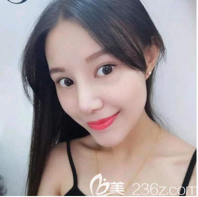 鼻綜合鼻翼縮小術(shù)后7天拆線效果圖