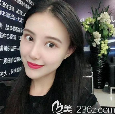 深圳米蘭柏羽鼻翼縮小術(shù)后半個月效果圖