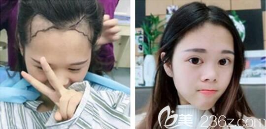 貴州利美康王昌林發(fā)際線種植 貴州利美康王昌林發(fā)際線種植