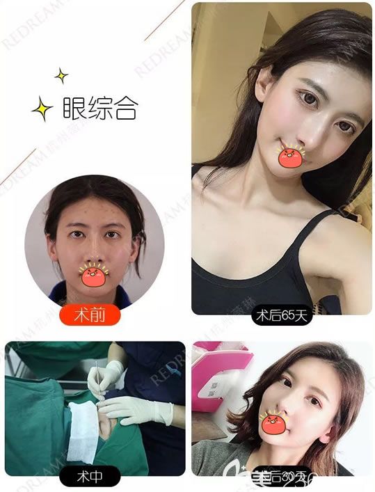 杭州薇琳索慧君割雙眼皮案例 杭州薇琳索慧君割雙眼皮案例