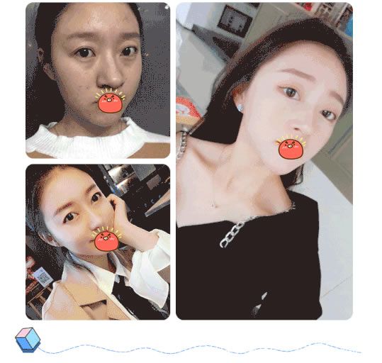 杭州薇琳醫(yī)院文章隆鼻案例 杭州薇琳醫(yī)院文章隆鼻案例