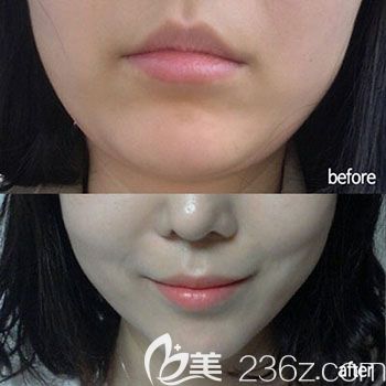 崔永澤院長(zhǎng)注射瘦臉案例